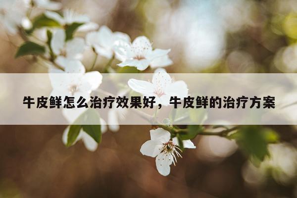 牛皮鲜怎么治疗效果好,牛皮鲜的治疗方案